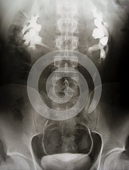 Intravenous urography, radiology test photo