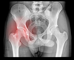 Intrinsic hip and pelvic pain on x-ray