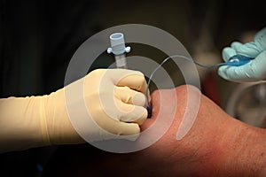Intubation of the patient`s trachea before surgery