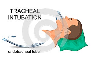 Intubation of the trachea. artificial ventilation of the lungs