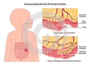 Intussusception. Congenital condition in which part of the intestine photo