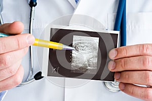 Intussusception of intestine in hepatic flexure of colon on ultrasound image concept photo. Doctor indicating by pen on printed pi