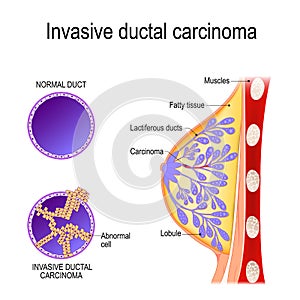 Invasive ductal carcinoma photo