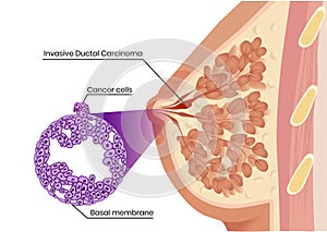 Invasive ductal carcinoma sctructure and pathology