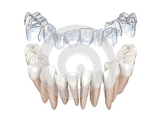 Invisalign braces or invisible retainer make bite correction. Medically accurate 3D animation