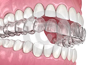 Invisalign braces or invisible retainer. Medically accurate dental 3D illustration