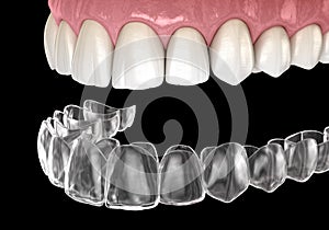 Invisalign braces or invisible retainer. Medically accurate dental 3D illustration photo