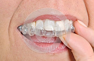 Invisible braces