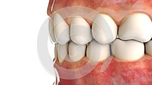 Invisible dental implant on white background - 3D Rendering