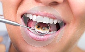 Invisible lingual braces