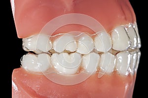 Invisible orthodontic aligner for treatments bruxism