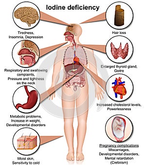 Iodine deficiency 3d medical vector illustration isolated on white background