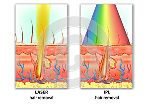IPL Intense Pulsed Light and Laser Hair Removal