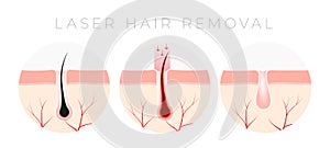 IPL Laser hair removal verctor illustration concept