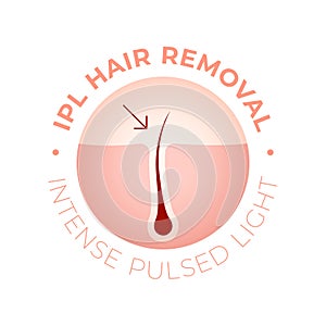 IPL Laser hair removal verctor illustration concept