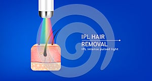 IPL light (Intense Pulsed Light) hair removal
