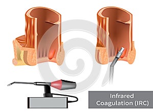 IRC Infrared Coagulation for Hemorrhoid Treatment. Nonoperative conservative options Hemorrhoid Treatments.