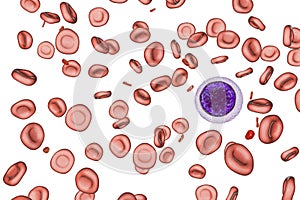 Iron deficiency anemia