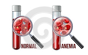 Iron deficiency anemia.The difference of Anemia amount of red blood cell and normal. photo