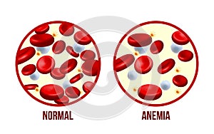 Iron deficiency anemia.The difference of Anemia amount of red blood cell and normal.