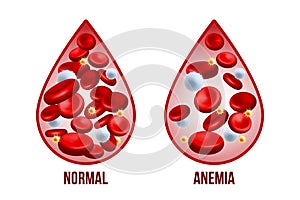 Iron deficiency anemia.The difference of Anemia amount of red blood cell and normal.