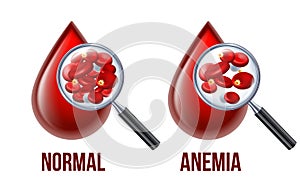 Iron deficiency anemia.The difference of Anemia amount of red blood cell and normal.