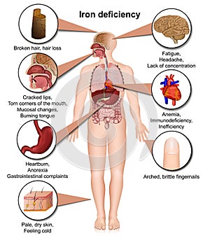 Iron deficiency body 3d medical vector illustration isolated on white background