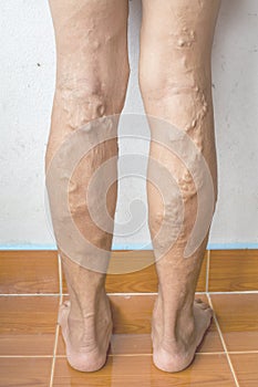 Irregular varicose veins on woman legs