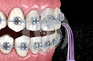 Irrigator cleaning braces with water jet. Medically accurate 3D illustration of oral hygiene