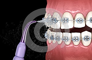 Irrigator cleaning braces with water jet. Medically accurate 3D illustration of oral hygiene