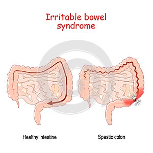 Irritable bowel syndrome