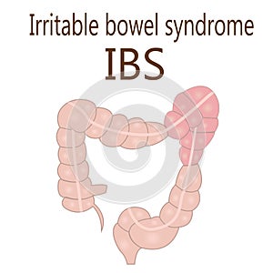 Irritable bowel syndrome IBS in a large intestine