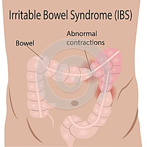 Irritable bowel syndrome IBS in a large intestine