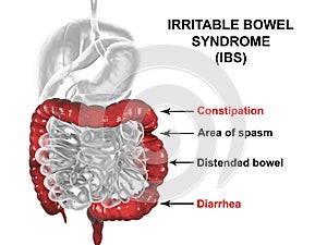 Irritable bowel syndrome IBS medical concept