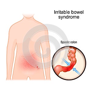 Irritable bowel syndrome. IBS photo