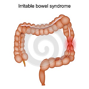 Irritable Bowel Syndrome. IBS Symptoms