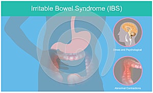 Irritable Bowel Syndrome. Illustration explain abnormal contractions and pain perception human bowel as a result of the brain