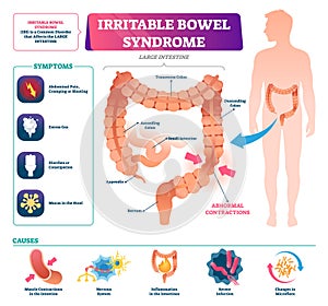 Irritable bowel syndrome vector illustration. Labeled medical disease graph photo