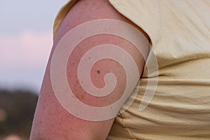 irritated sunburn on womans arm in summer