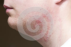 Irritation after shaving on the neck of a man, close-up