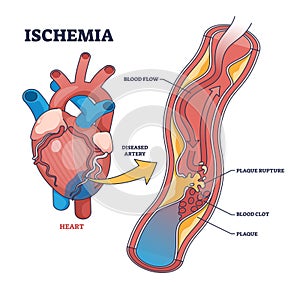 Ischemia as medical condition with blood flow blockage outline diagram