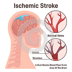 Ischemic brain stroke concept. Thrombus in the cerebral artery