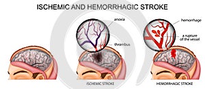 Ischemic and hemorrhagic stroke