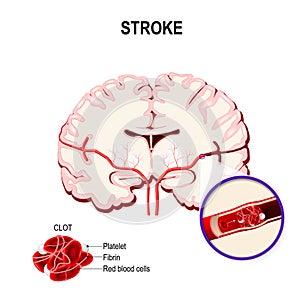 Ischemic stroke in the cerebral artery and thrombus.