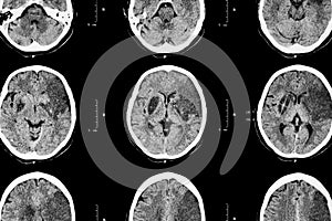 Ischemic stroke : ( CT of brain show cerebral infarction at left frontal - temporal - parietal lobe ) ( nervous system background