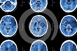 Ischemic stroke : ( CT of brain show cerebral infarction at left frontal - temporal - parietal lobe ) ( nervous system background photo