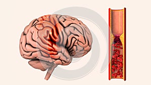 Cerebrovascular disease is an ischemic stroke