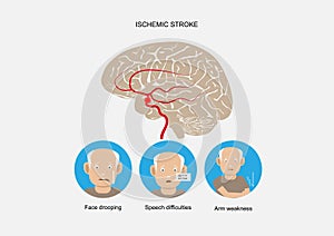 Ischemic stroke and waring signs and symptoms