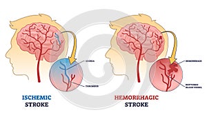 Ischemic vs hemorrhagic head stroke anatomical comparison outline diagram