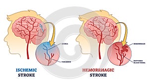Ischemic vs hemorrhagic head stroke anatomical comparison outline diagram photo